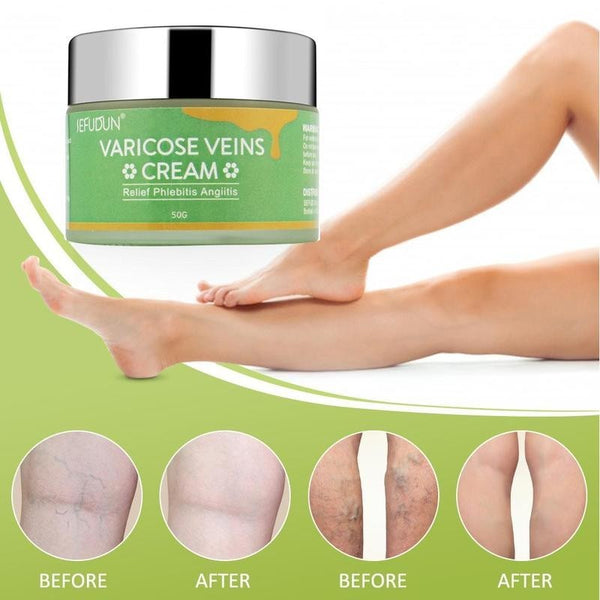 🌿 Soothing Varicose Vein Cream – Reduce Swelling & Discomfort

